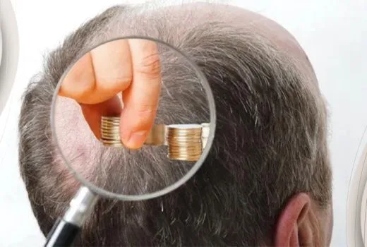 Cost Of Hair Transplant In Turkey