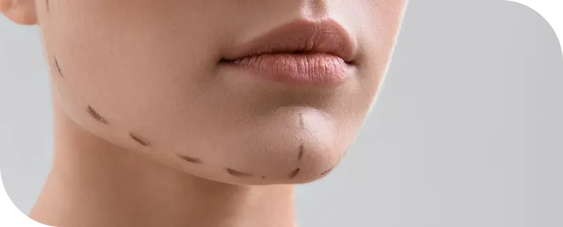 Double Chin Liposuction In Turkey