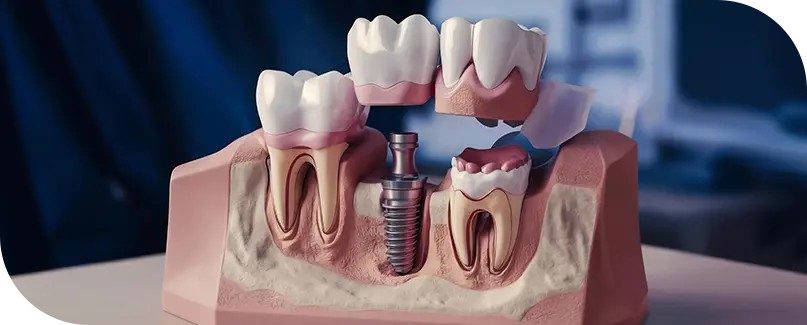 Dental And Teeth Implants In Turkey