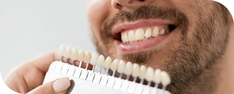 Dental Veneers